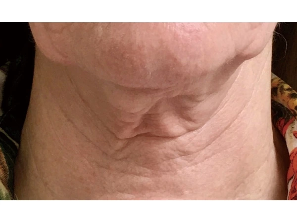 Filling &Lifting & Tightening