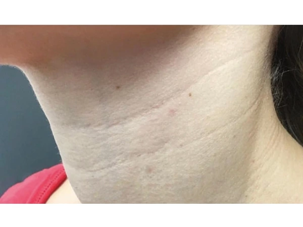 Skin Filling & Wrinkle Removal