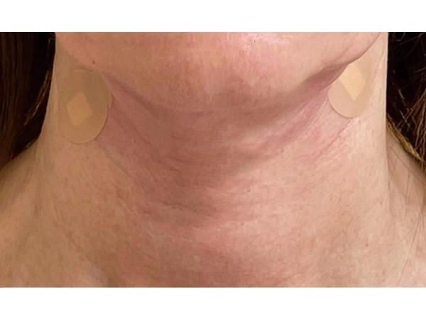 Filling &Lifting & Tightening