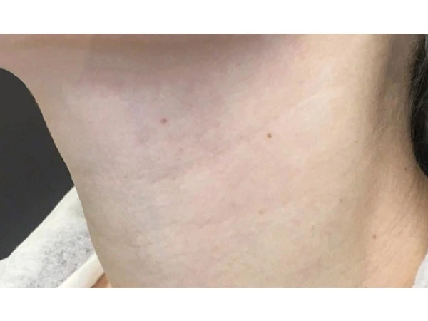 Skin Filling & Wrinkle Removal