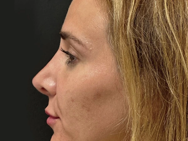 Skin Filling & Wrinkle Removal