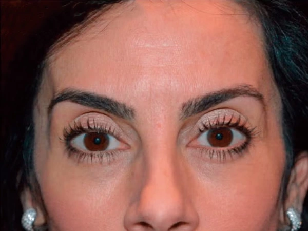 Skin Filling & Wrinkle Removal