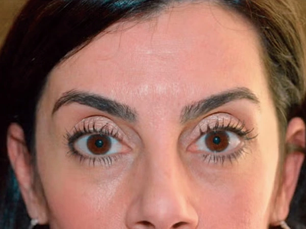 Skin Filling & Wrinkle Removal